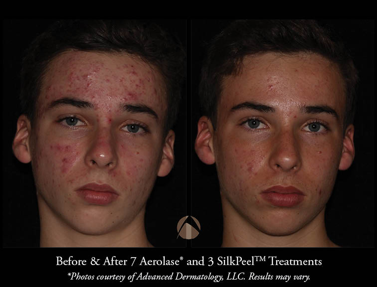 Aerolase LightPod Neo® Acne Laser Treatment Chicago, IL Advanced