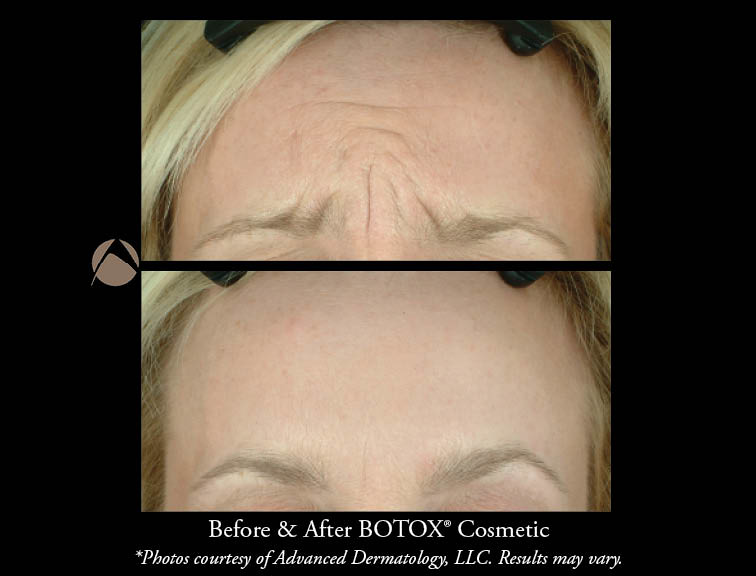 The Best Illinois Botox 2022