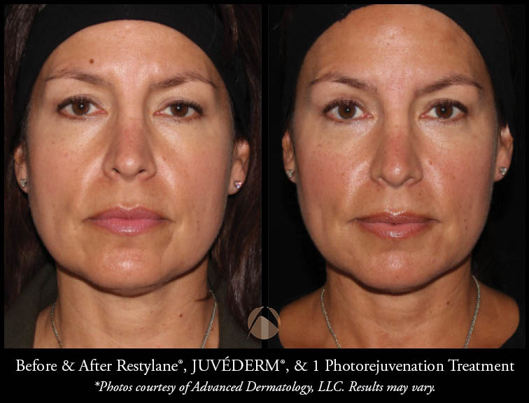Specializing in Restylane, Restylane Lyft, Juvederm, & Belotero Fillers