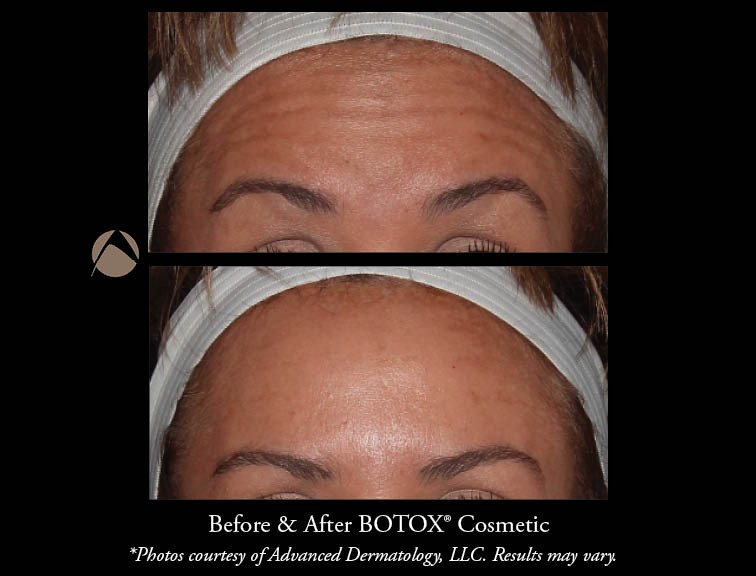 Cosmetic Botox Injections & Treatments Chicago, IL Advanced Dermatology