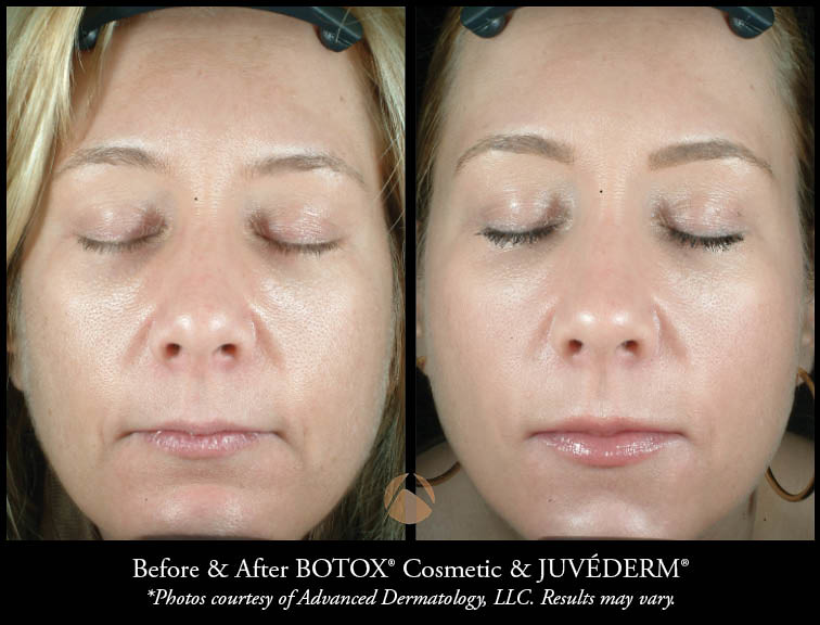 Cosmetic Botox Injections & Treatments Chicago, IL Advanced Dermatology