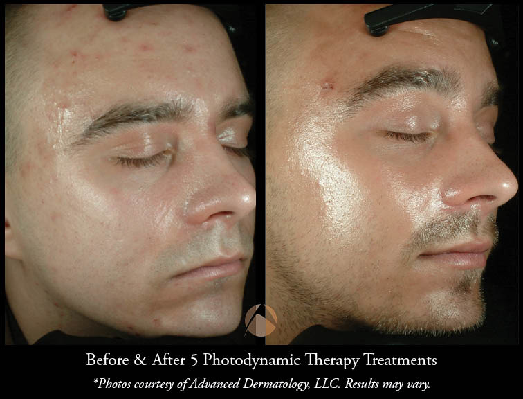 Photodynamic Therapy for Acne PDT Chicago, IL Advanced Dermatology