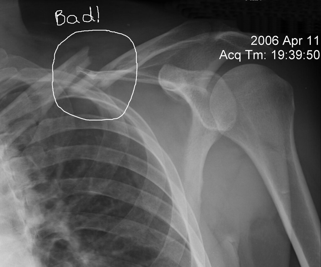 Broken clavicle surgery or not? Road Bike, Cycling Forums