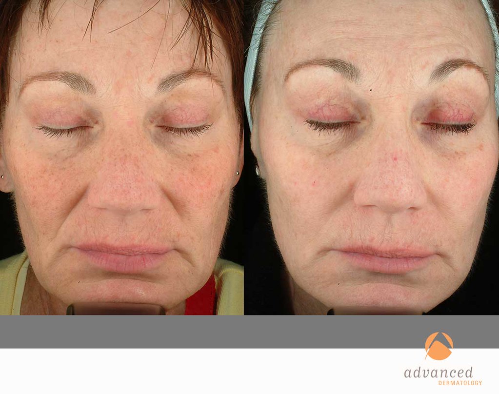 Photodynamic Therapy Levulan Chicago, IL Advanced Dermatology