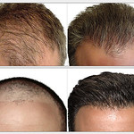 hair transplant Dubai