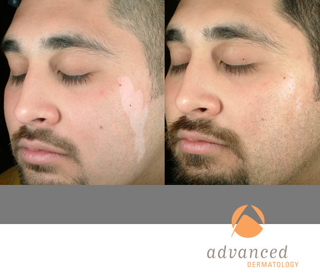 Xtrac Laser Therapy Treatment Chicago, IL Advanced Dermatology