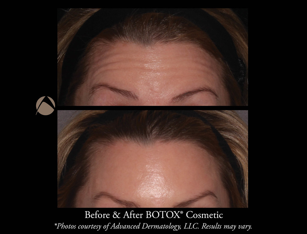 Cosmetic Botox Injections & Treatments Chicago, IL Advanced Dermatology