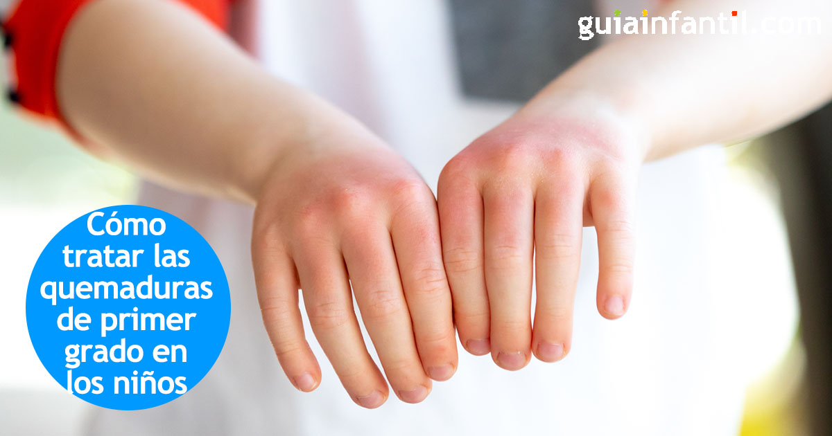Cura de las heridas por quemaduras a los niños, paso a paso