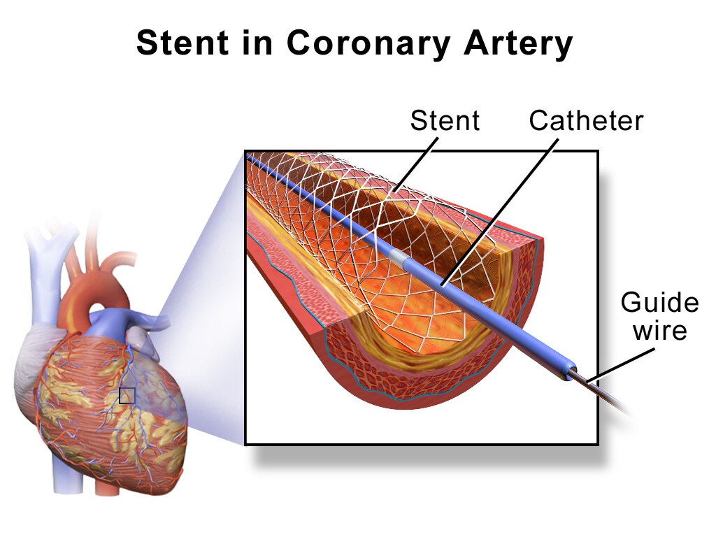 Central government slashes prices of cardiac stents by up to 85, much