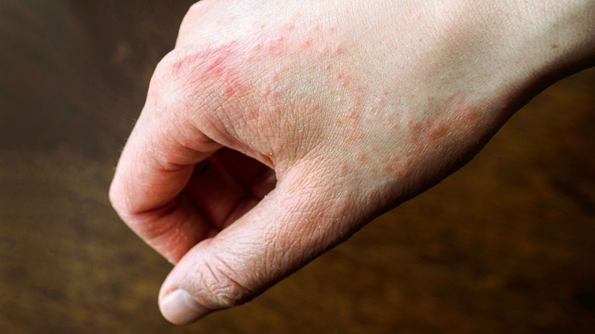 Covid Precaution is Causing Dermatitis to 2/3rd Population, Find