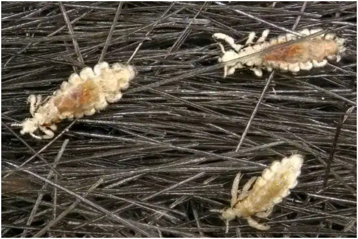 Lice In Rainy Season बारिश के मौसम में बच्चों के सिर में पड़ गए हैं