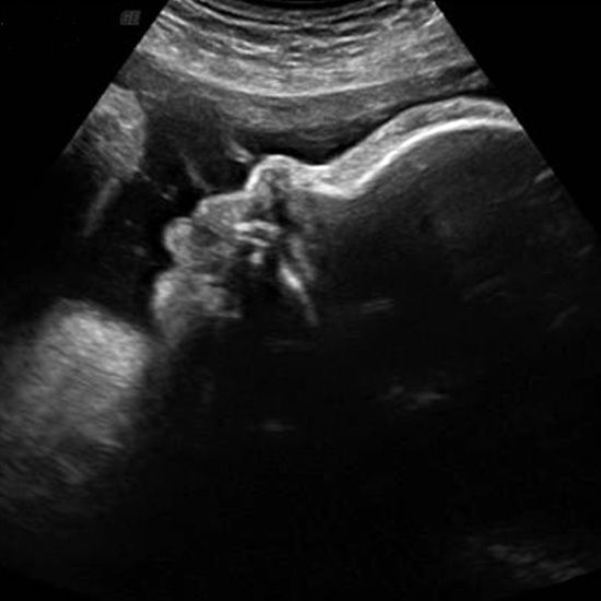 Week 36 Ultrasound What It Would Look Like Parents