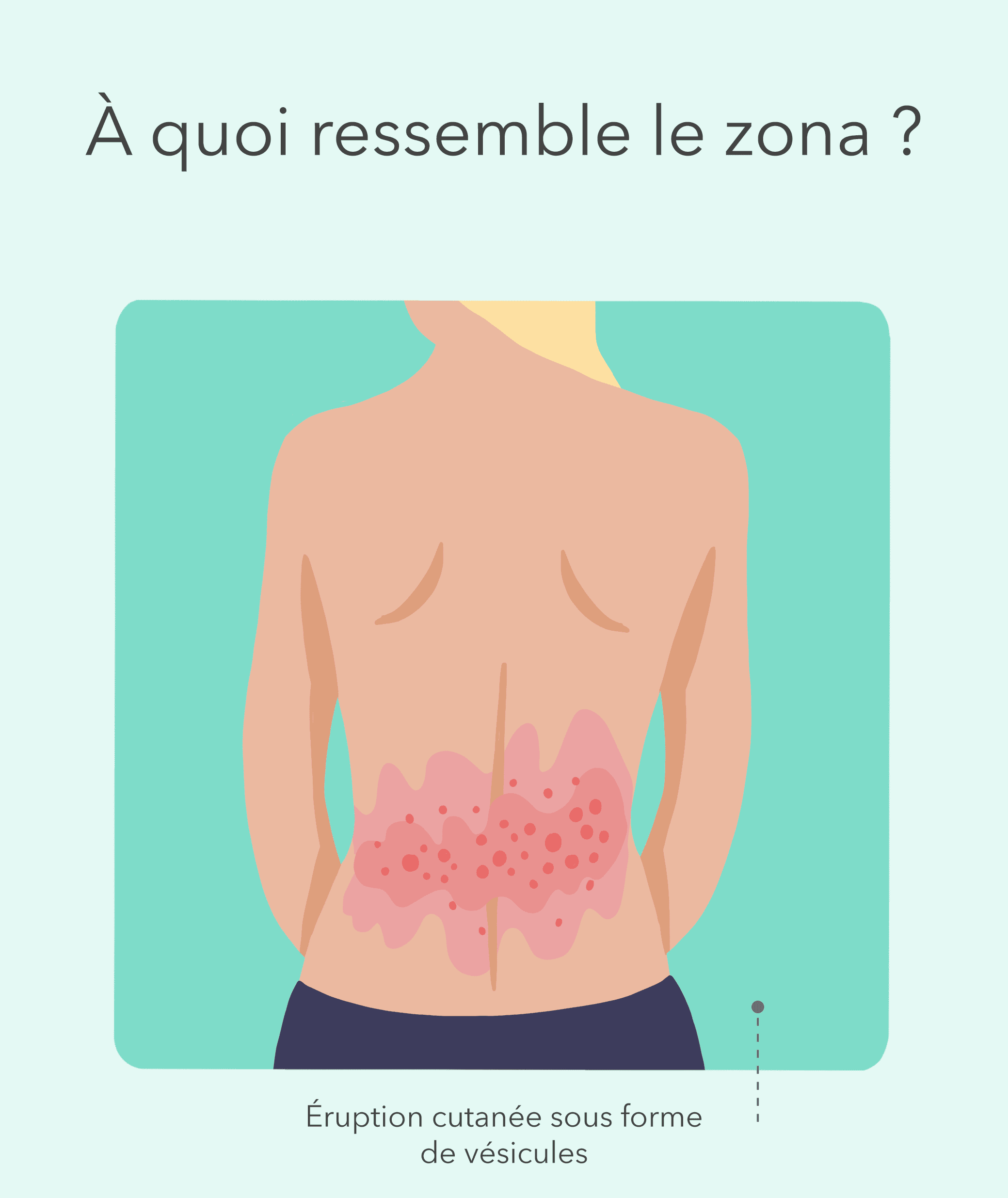 Zona qu est ce que le zona, Symptômes et Traitement SHOP PHARMACIE