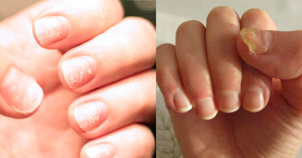 How Your Fingernails Might Indicate Something Is Wrong With Your Health