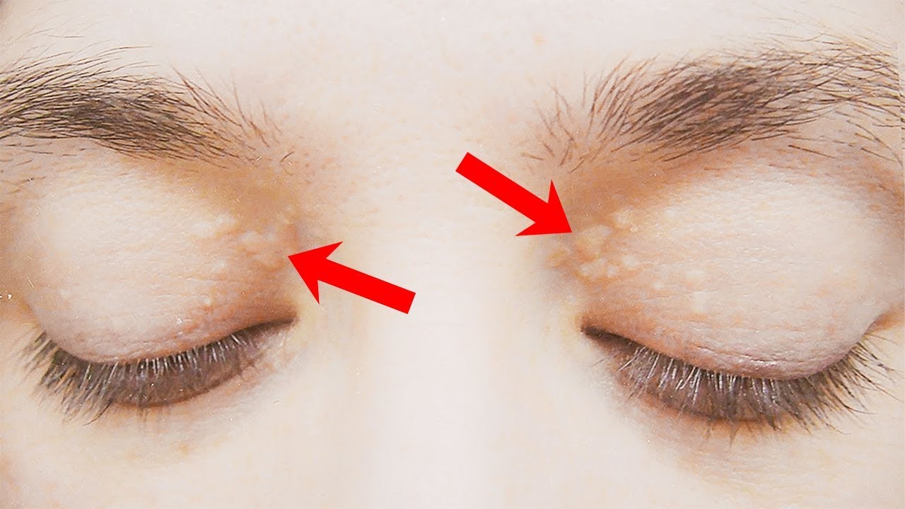 How to Get Rid of Cholesterol Deposits Around Your Eyes Small Joys