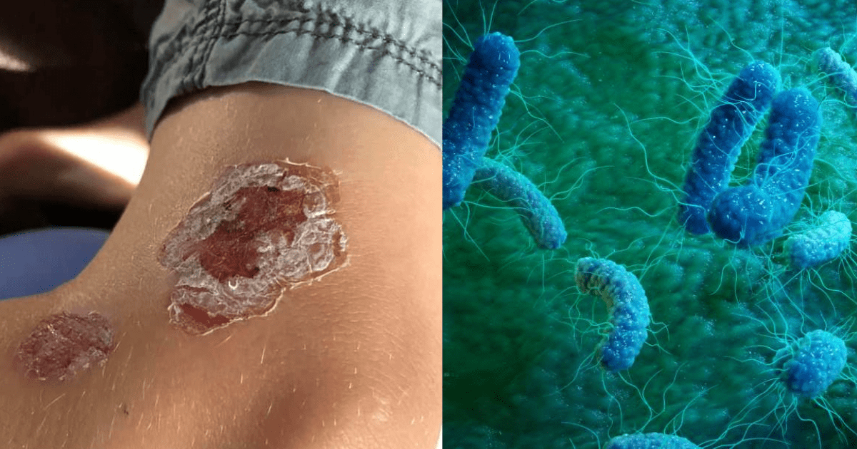 Mom Warns Son to Get Somewhere Fast When He Contacts A FleshEating