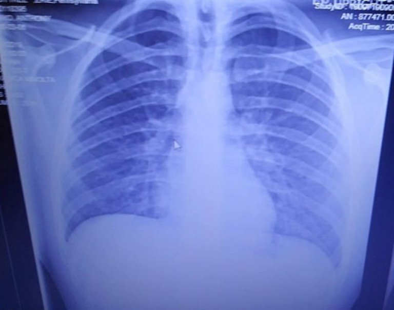 Scans Revealed How Vaping Left Teen's Lungs Filled With Solidified OIL