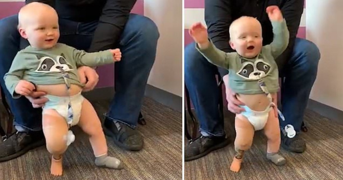 Boy Who Was Born With One Leg Danced With Joy After His Prosthetic