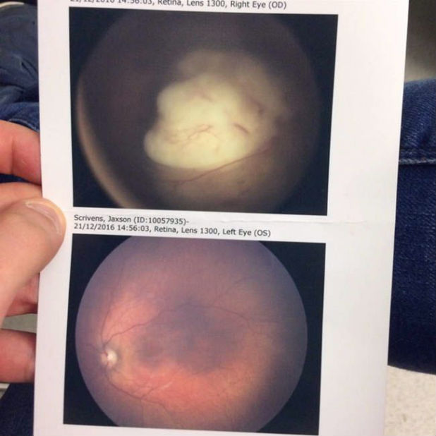Flash photo reveals cancer in British toddler's eye Stuff.co.nz