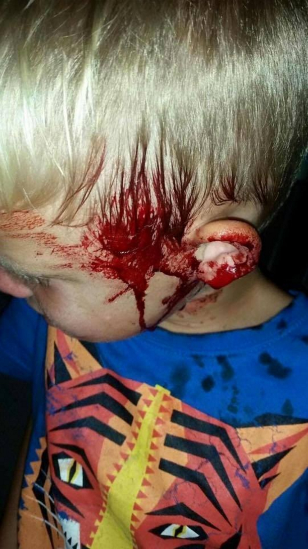 Snake bites boy's face as he sleeps Stuff.co.nz