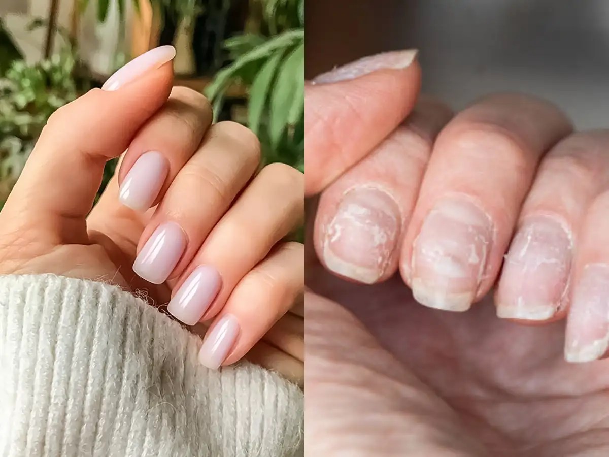 Allergic reaction Woman's nails started peeling away from her nail bed