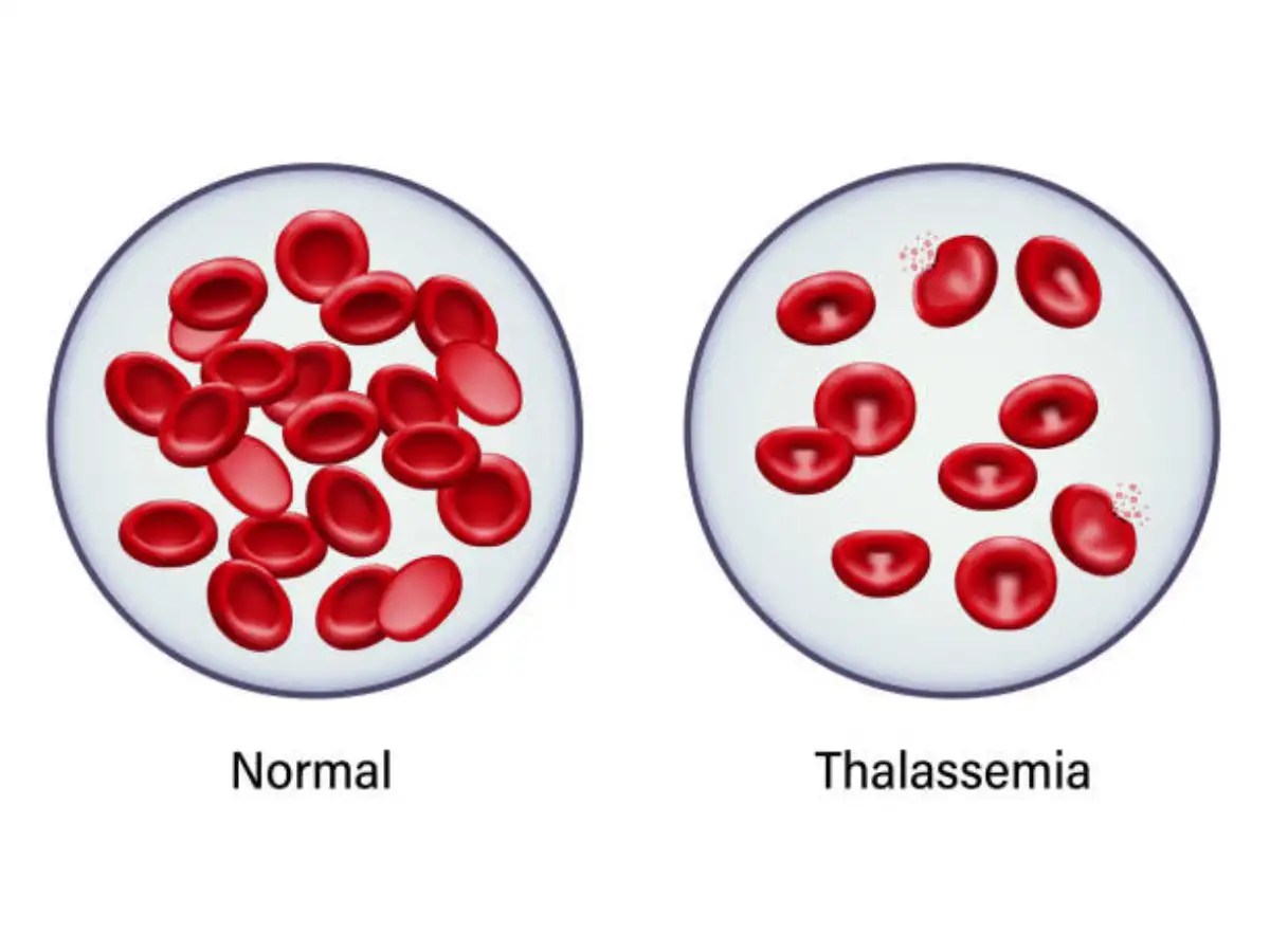 Thalassemia Here’s all you need to know about the blood disorder
