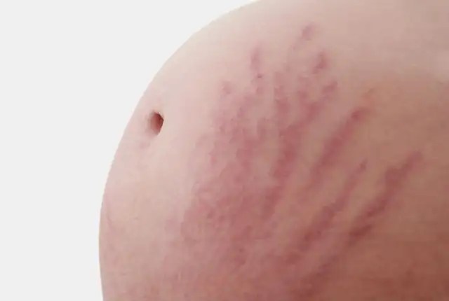 White Stretch Marks: The Difference Between Red And White Stretch Marks - Times Of India