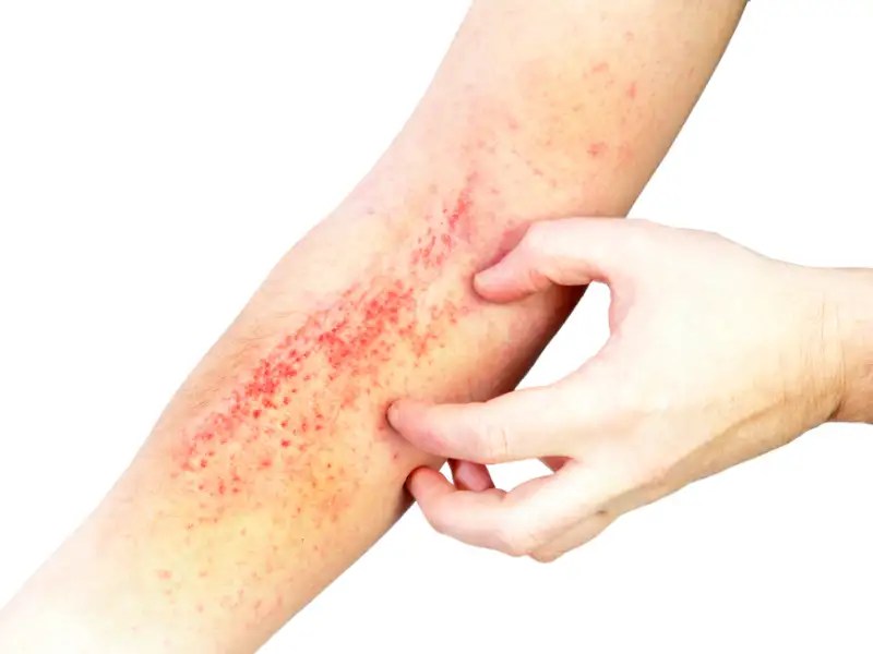 Ends Skin Inflammation