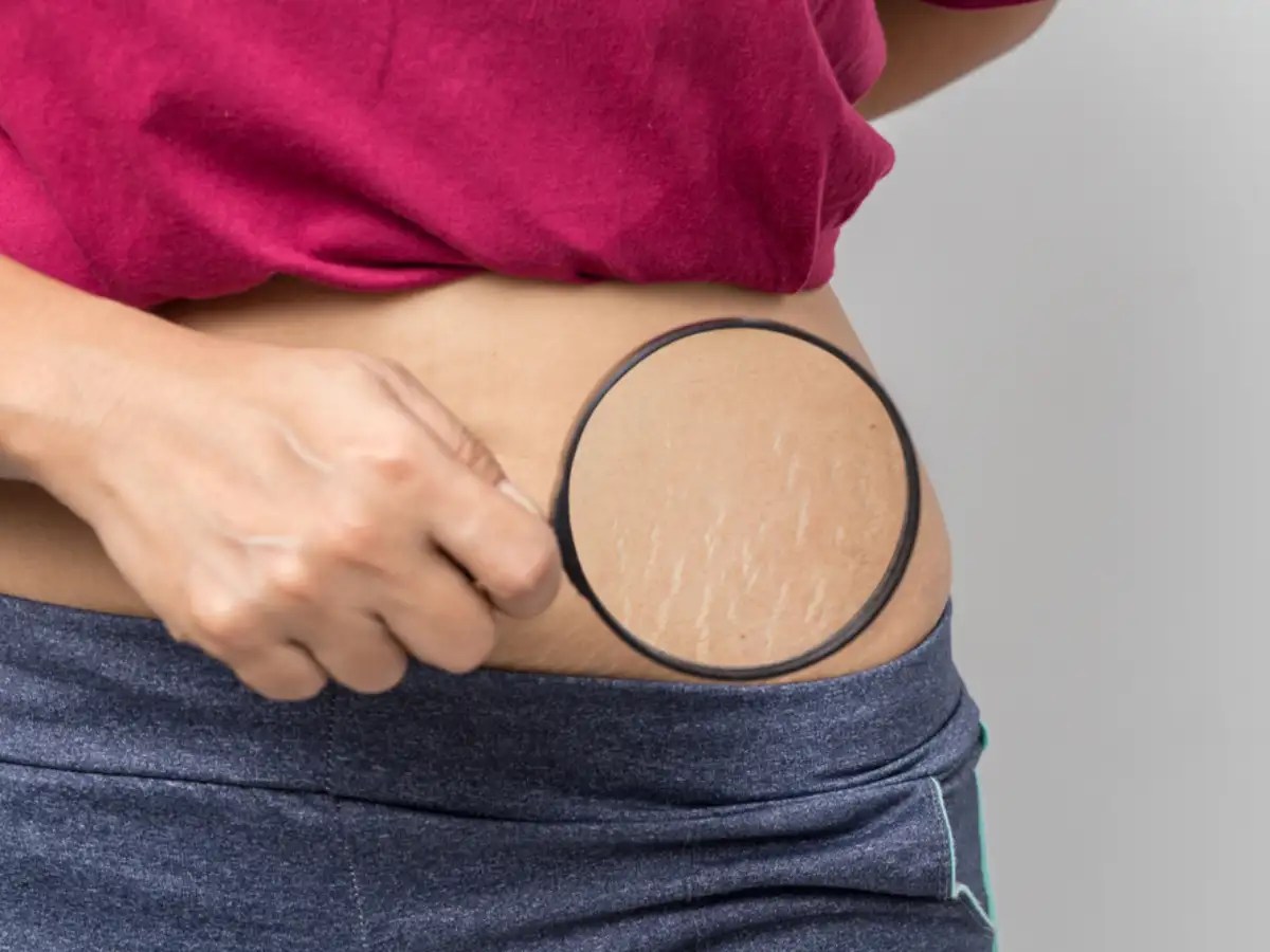 Pregnancy Stretch Marks Home Remedies How to Get Rid of Pregnancy