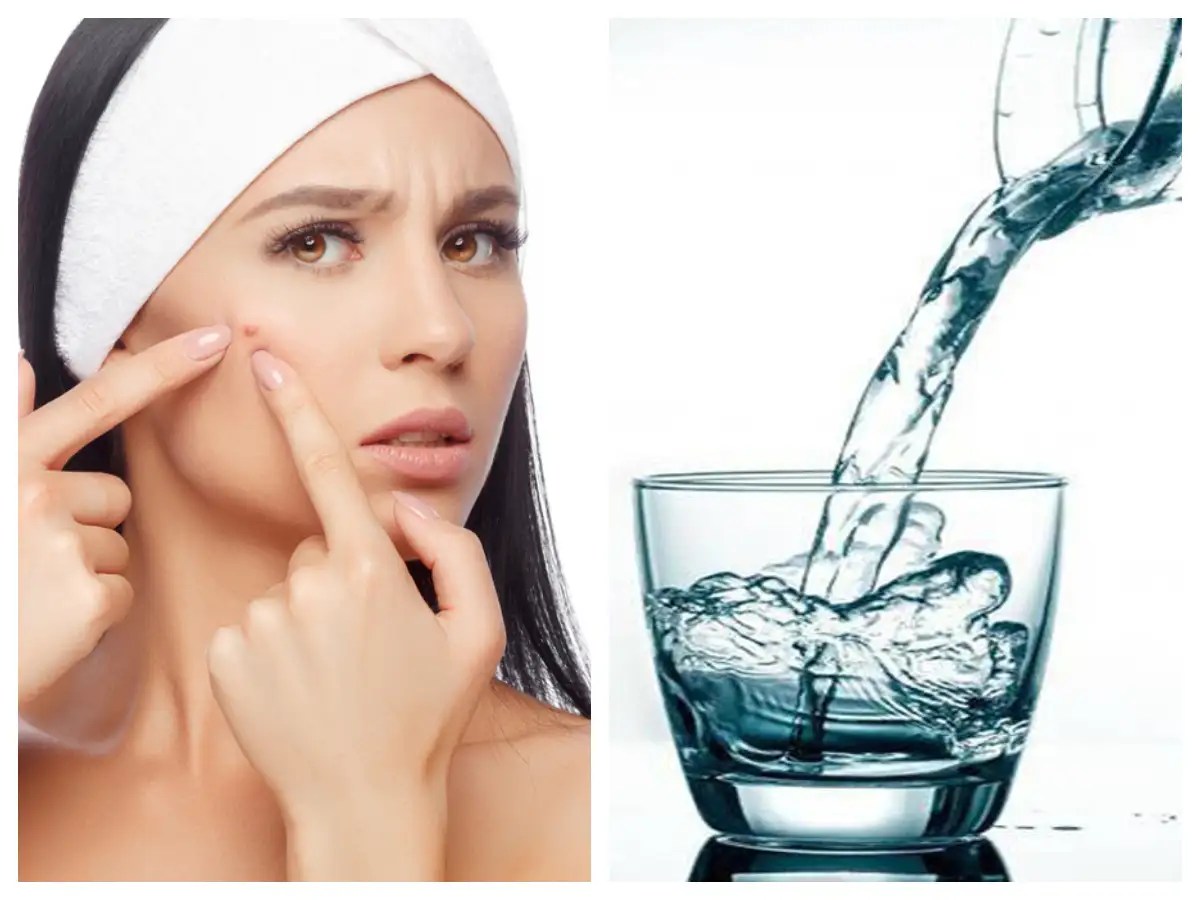 Drink water to get rid of those pimples! The Times of India