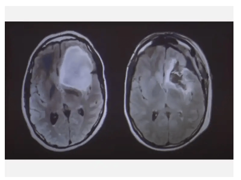 Brain Tumours Types, Symptoms & Treatment Times of India