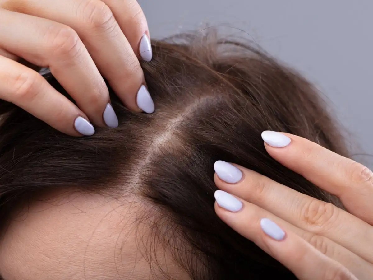 Tired Of Itchy Pimples On Your Scalp? Here's What You Can Do To Treat Them | The Times Of India