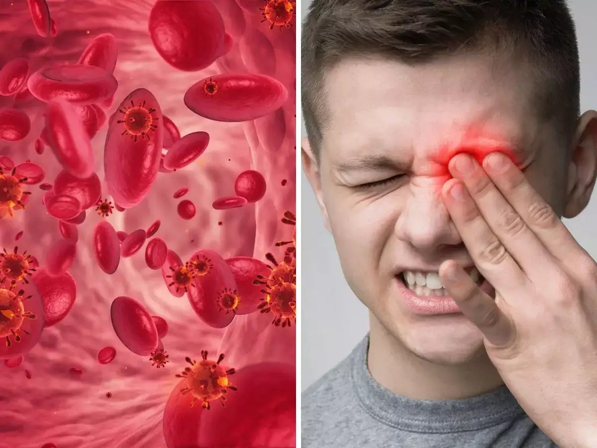 Iron Deficiency Anemia Eyes