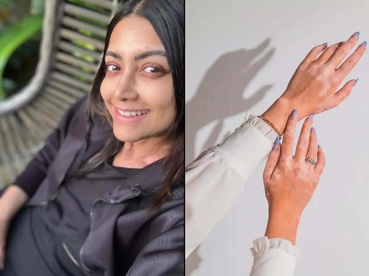 South actress Mamta Mohandas diagnosed with vitiligo; here's everything