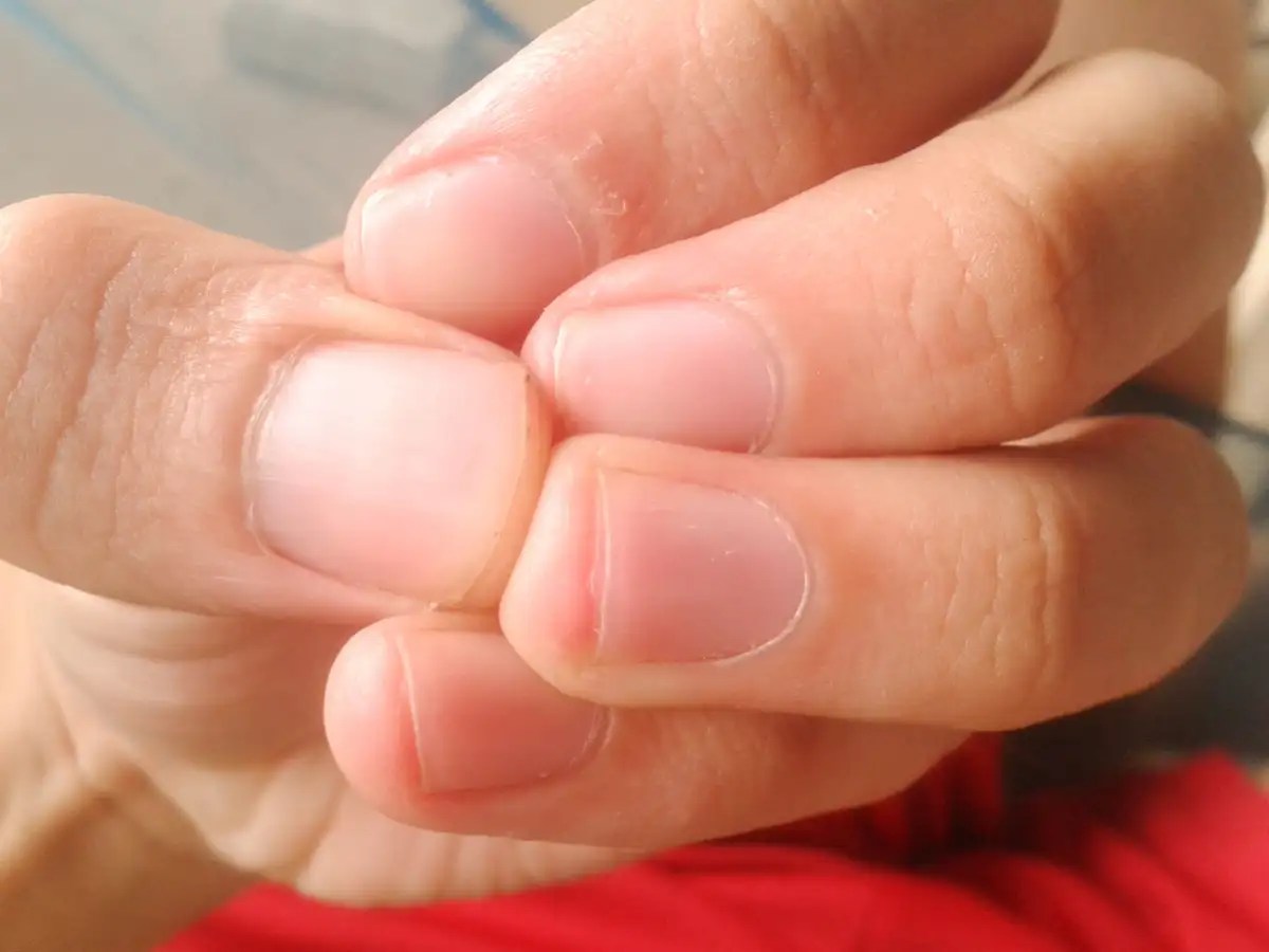 High cholesterol signs in fingers and toes RB city