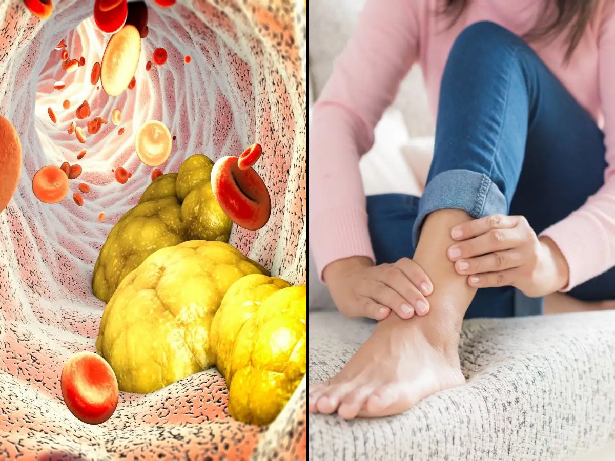 High cholesterol Symptoms Leg pain that stops within a few minutes of