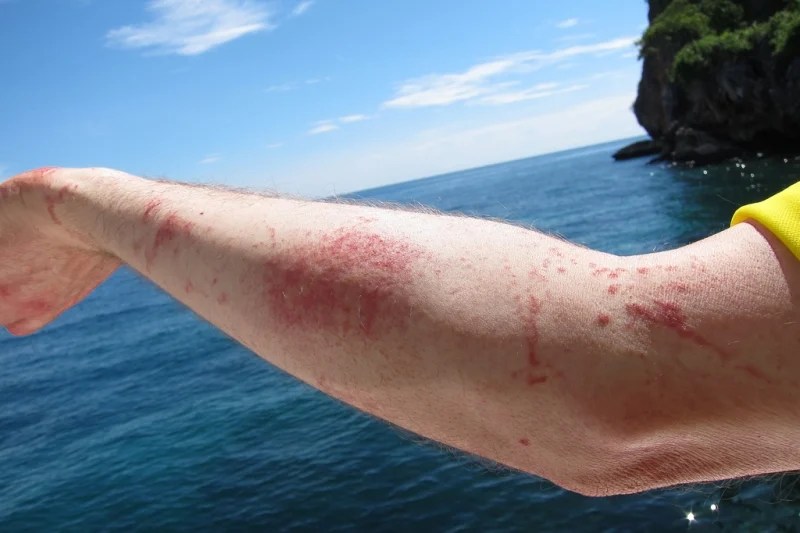 First Aid MustKnows What To Do When a Jellyfish Stings