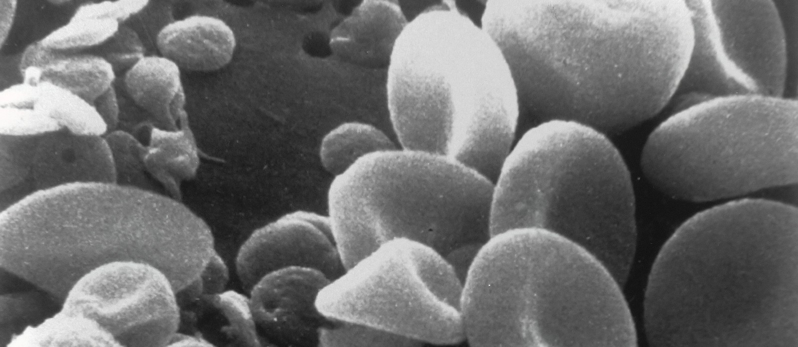 Which disorder stops blood clotting?