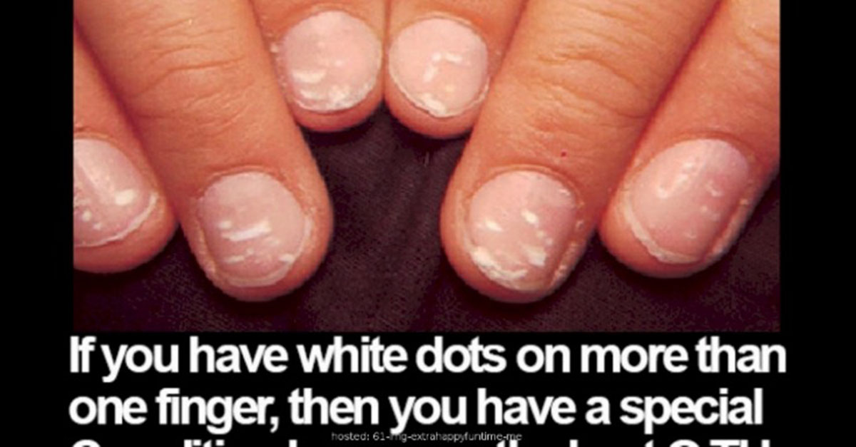 Those White Dots On Your Fingernails Can Indicate a Lot