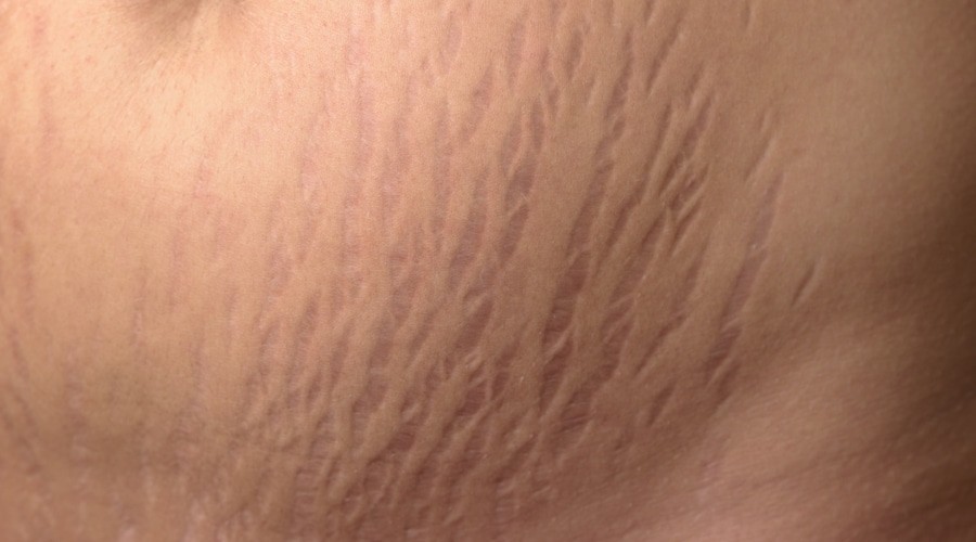 تشققات الجلد على الثدي ويب طب