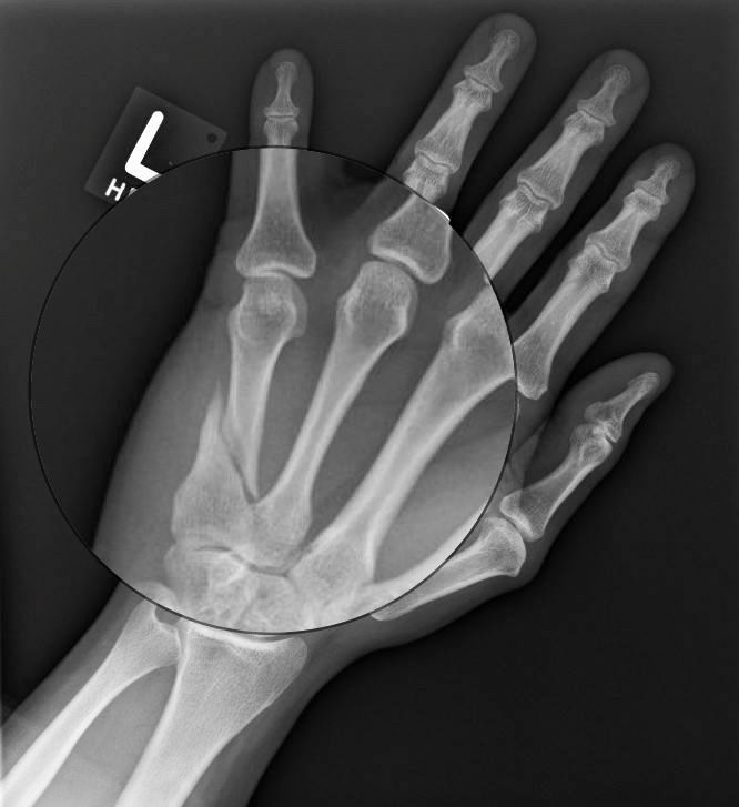 Surgical Indications and Treatment of a Metacarpal Fracture