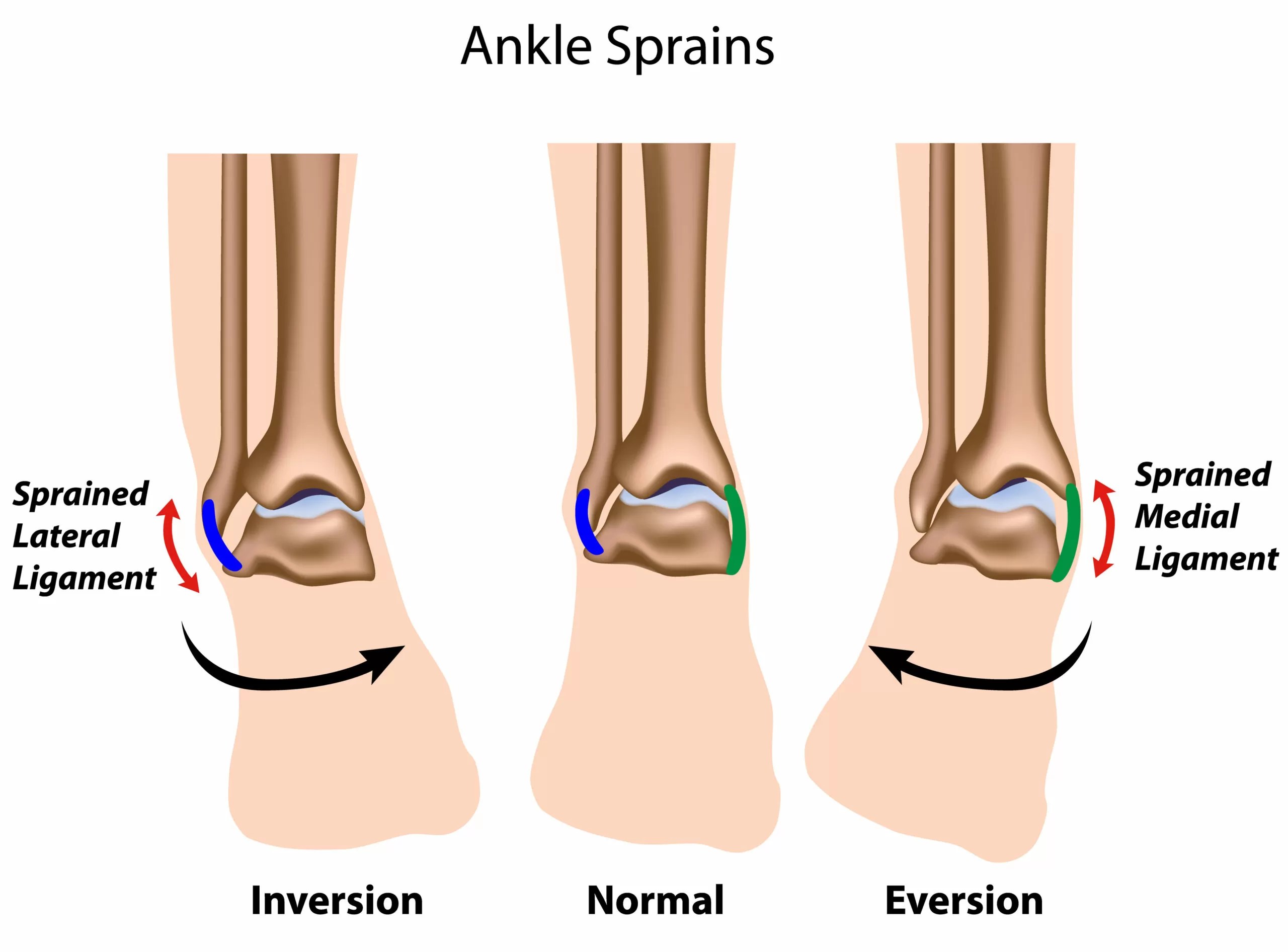Understanding Ankle Sprains