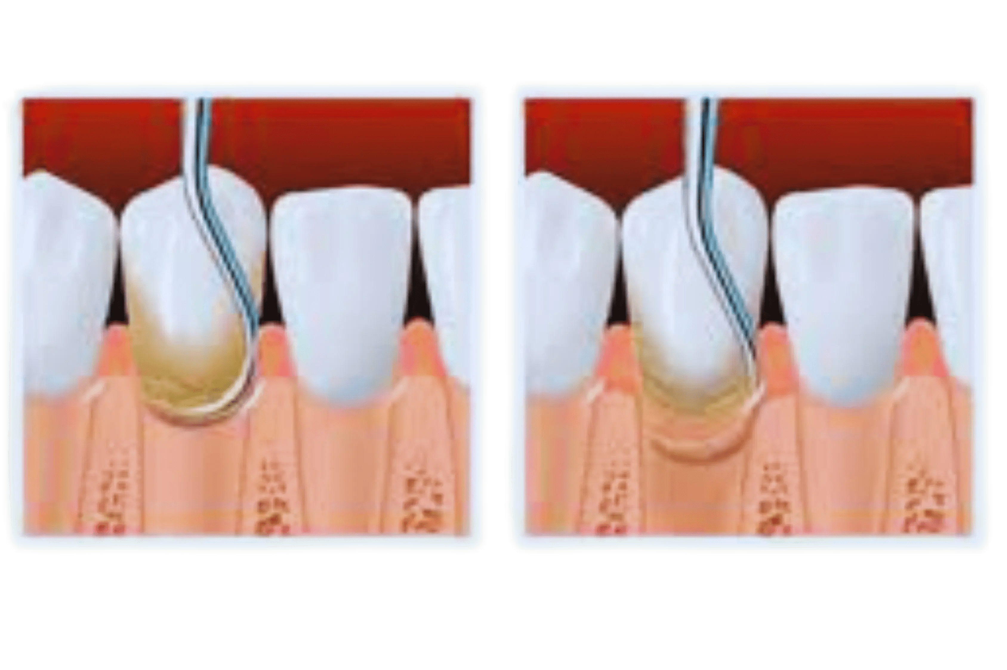 Subgingival Curettage Procedure in Izmir, Turkey Dentglow