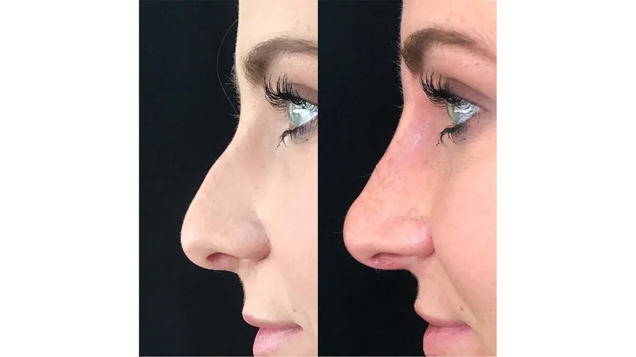 NonSurgical Rhinoplasty Cost in Doha, Qatar