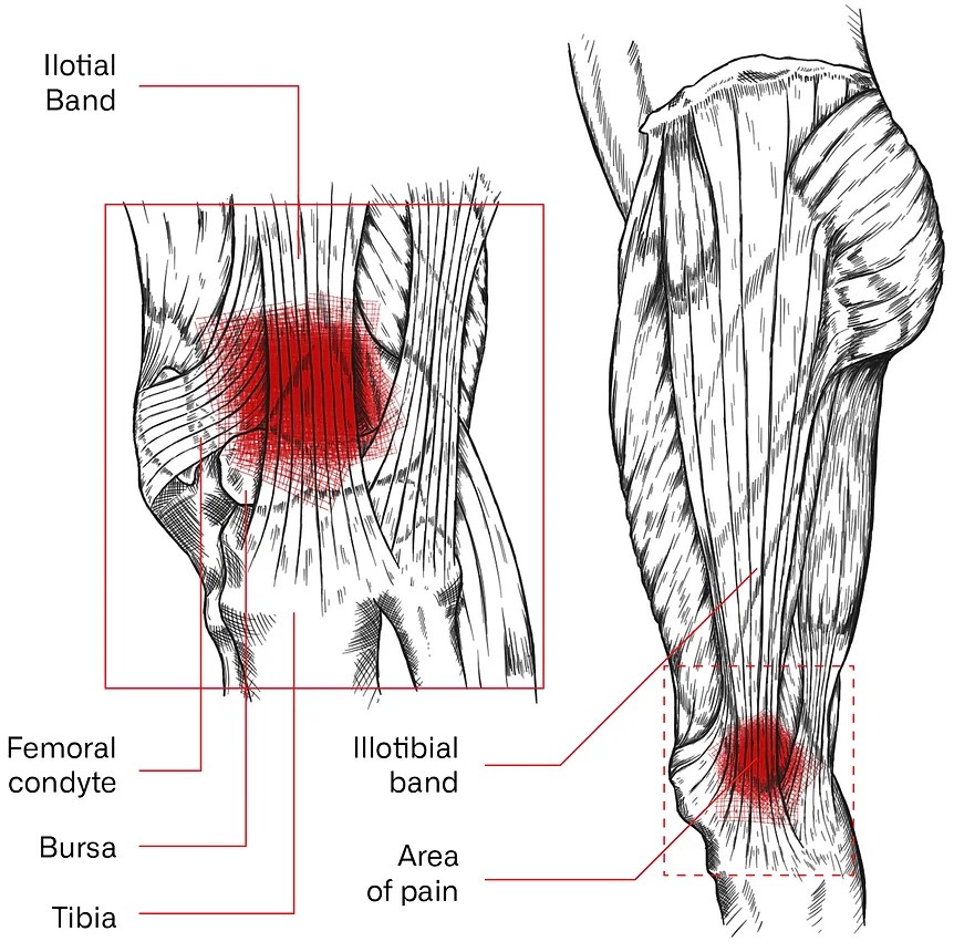 IT Band Syndrome