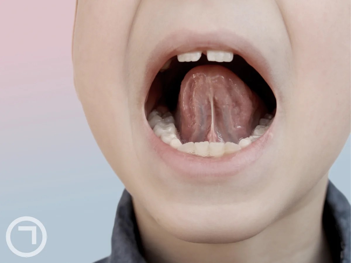 How to Deal With a Torn Frenulum Lip