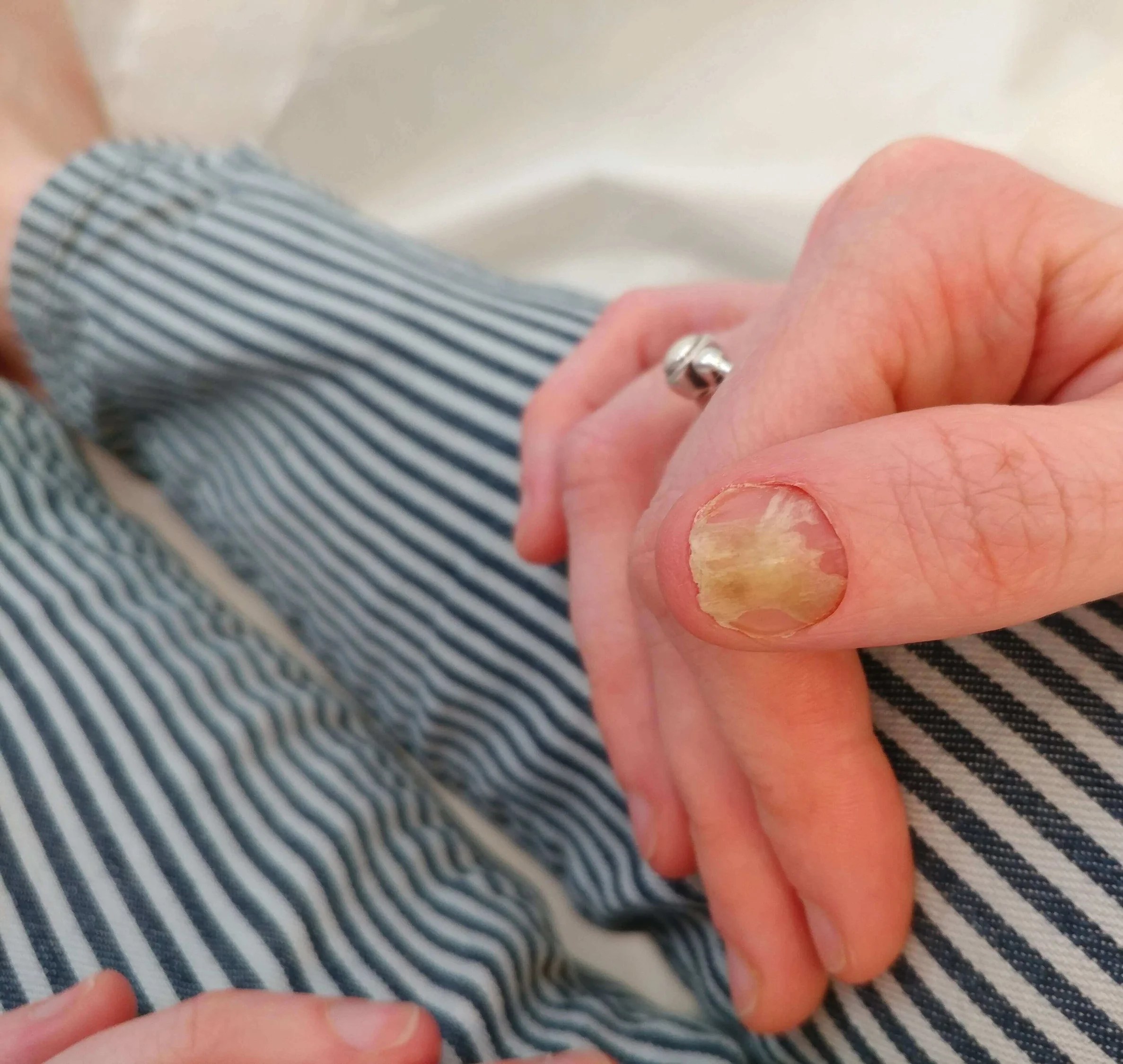 Demystifying Myths About Fungal Toenail