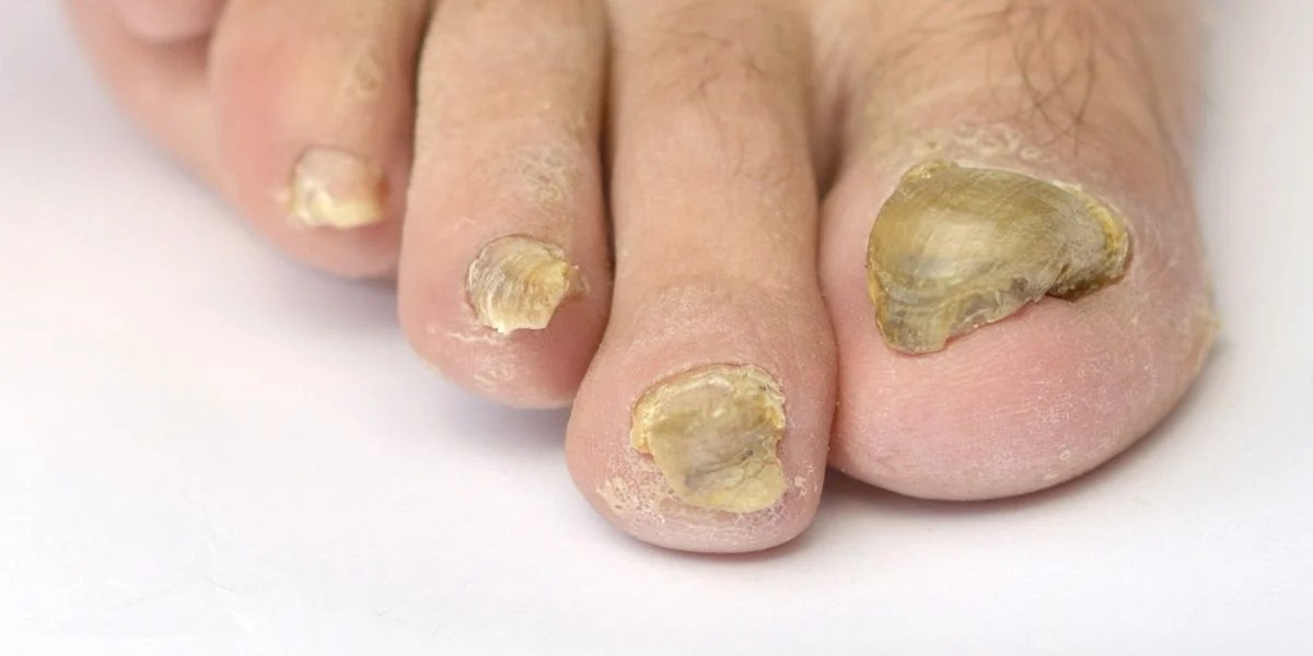 Fungal Nail Surgery fungalnaillaserdr