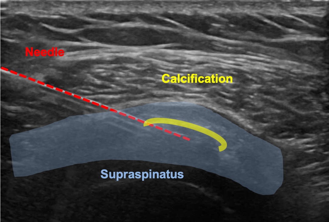 How is shoulder barbotage/lavage "treating calcific tendonitis" done?