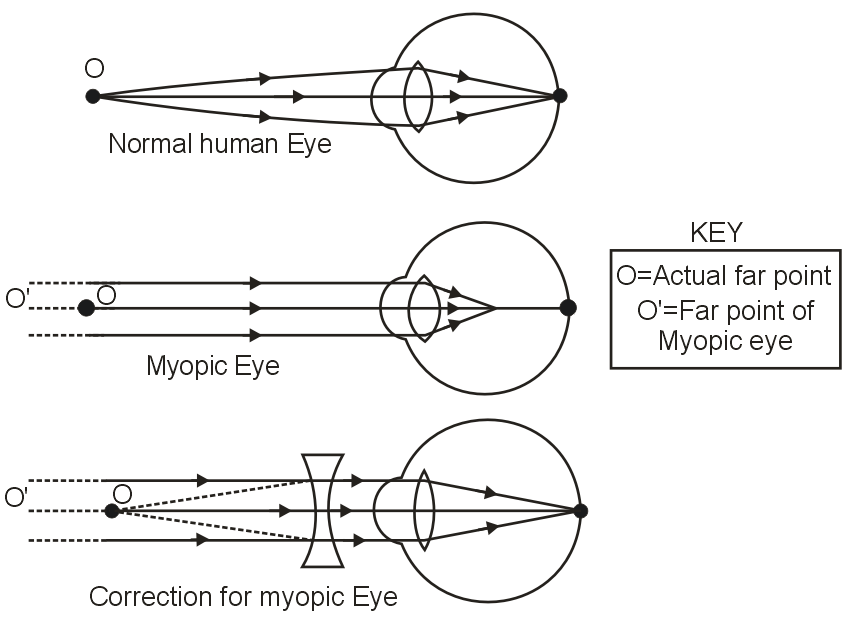 What is myopia? Explain two possible reasons of myopia. How can it be